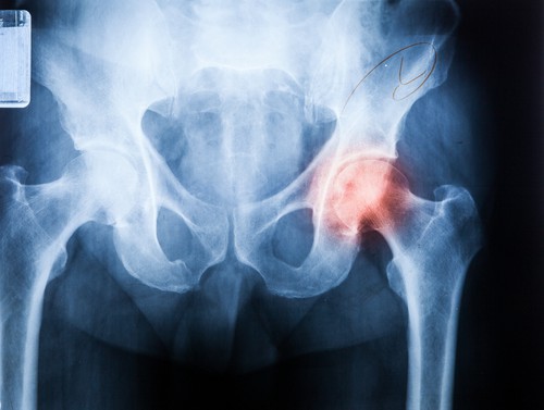 Life After A Hip Replacement | KERA